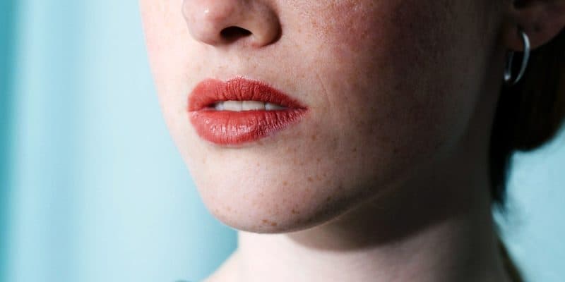 chin acne