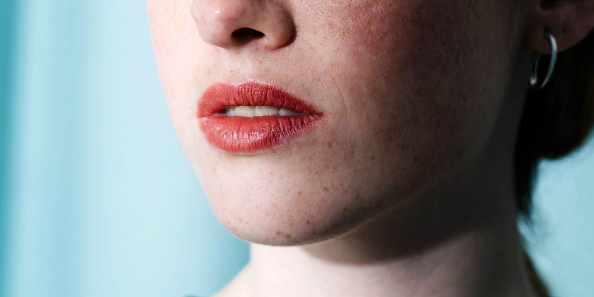 how-to-get-rid-of-chin-acne-iamra