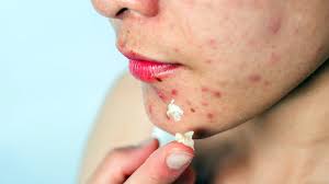 moisturizer for acne