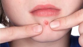 popping cystic acne